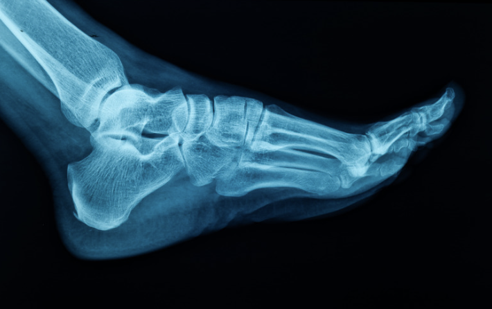 foot xray